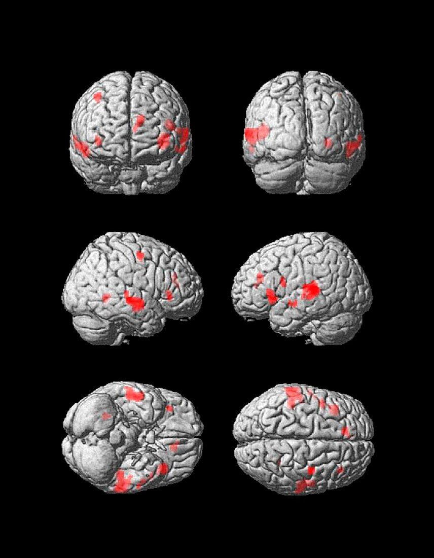 Brain under hypnosis,3D MRI scans