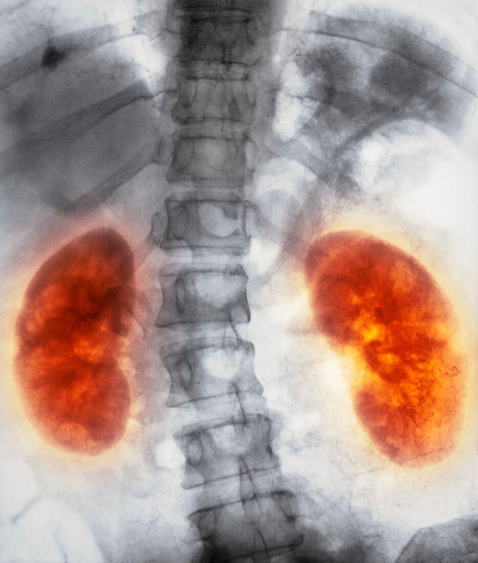 Healthy kidneys,X-ray