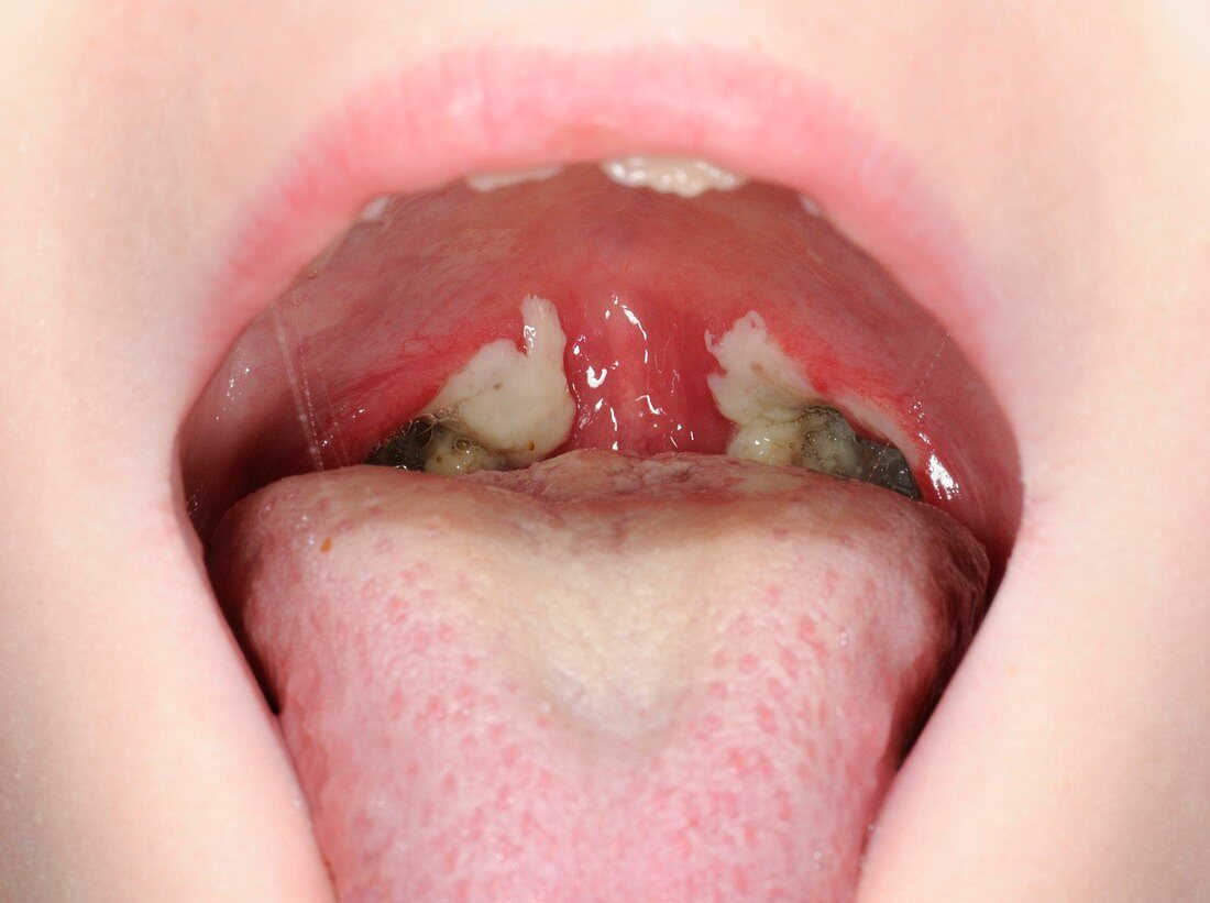 Throat after tonsillectomy