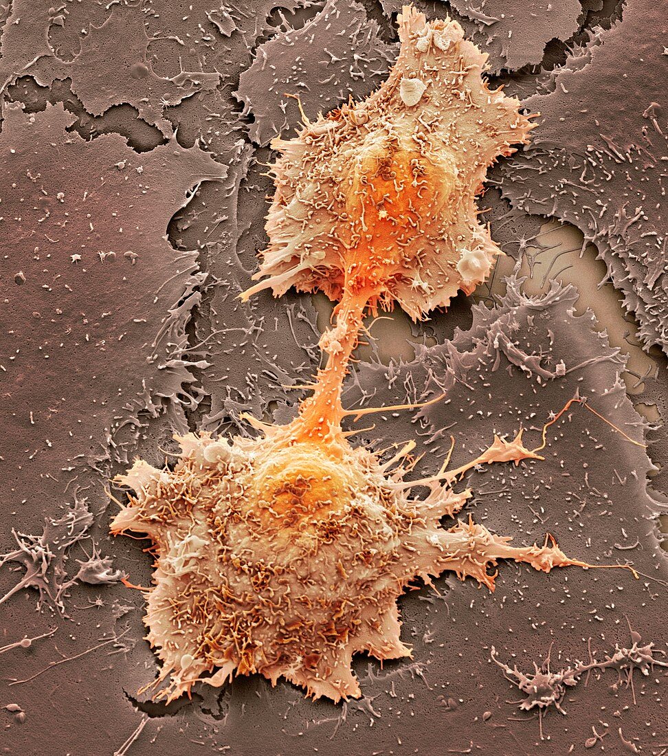 Mouth cancer cell dividing,SEM