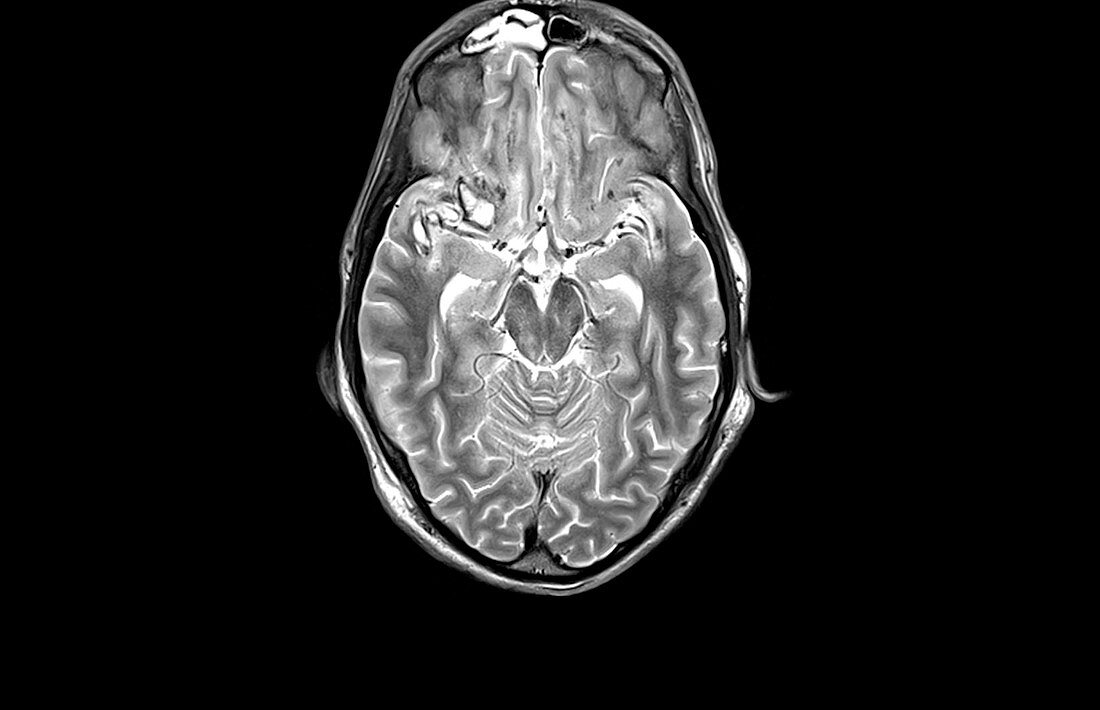Brain injury,MRI scan