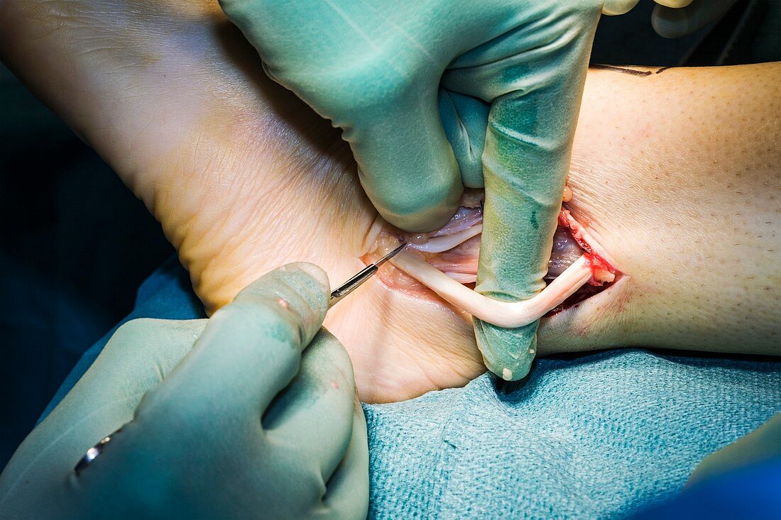 Cavus foot surgery,ankle tendons