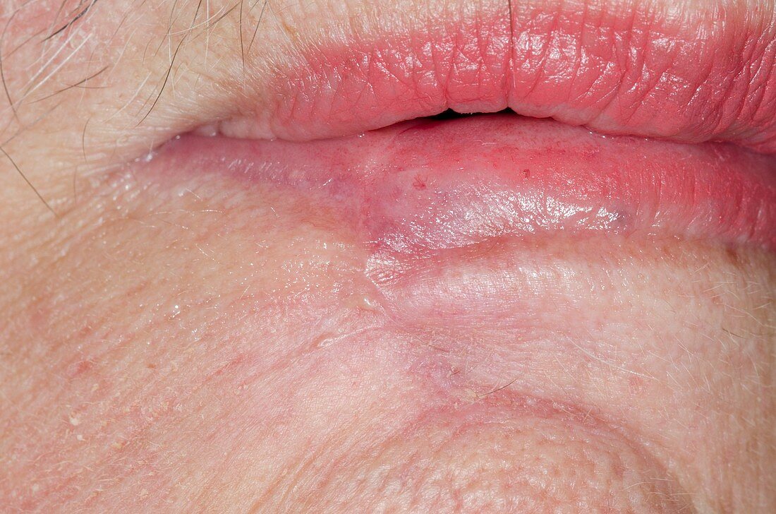 Excised skin cancer of the lip