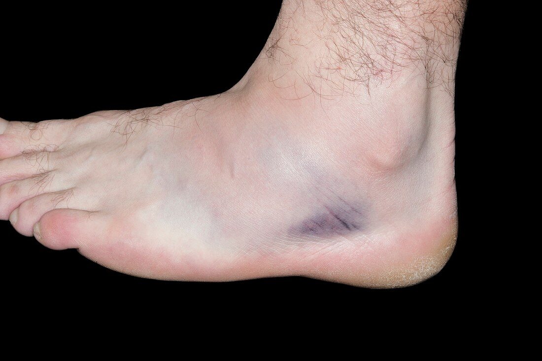 Sprained ankle