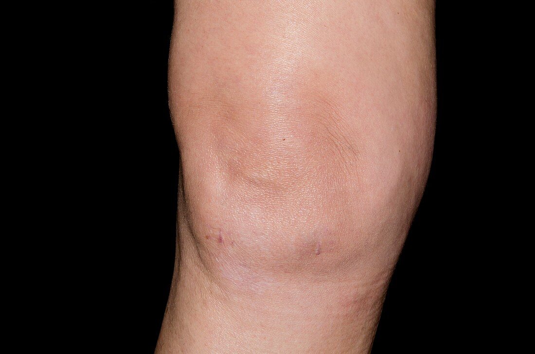 Effusion of the knee after surgery