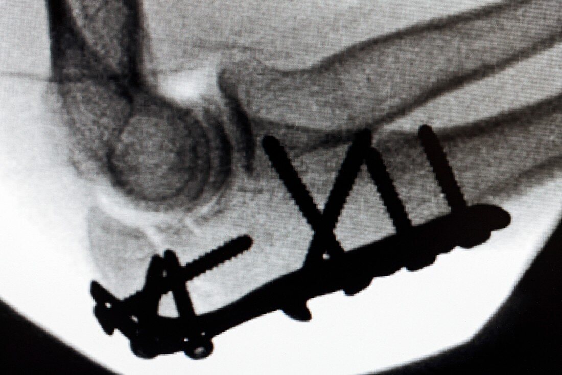 Pinned broken elbow,X-ray