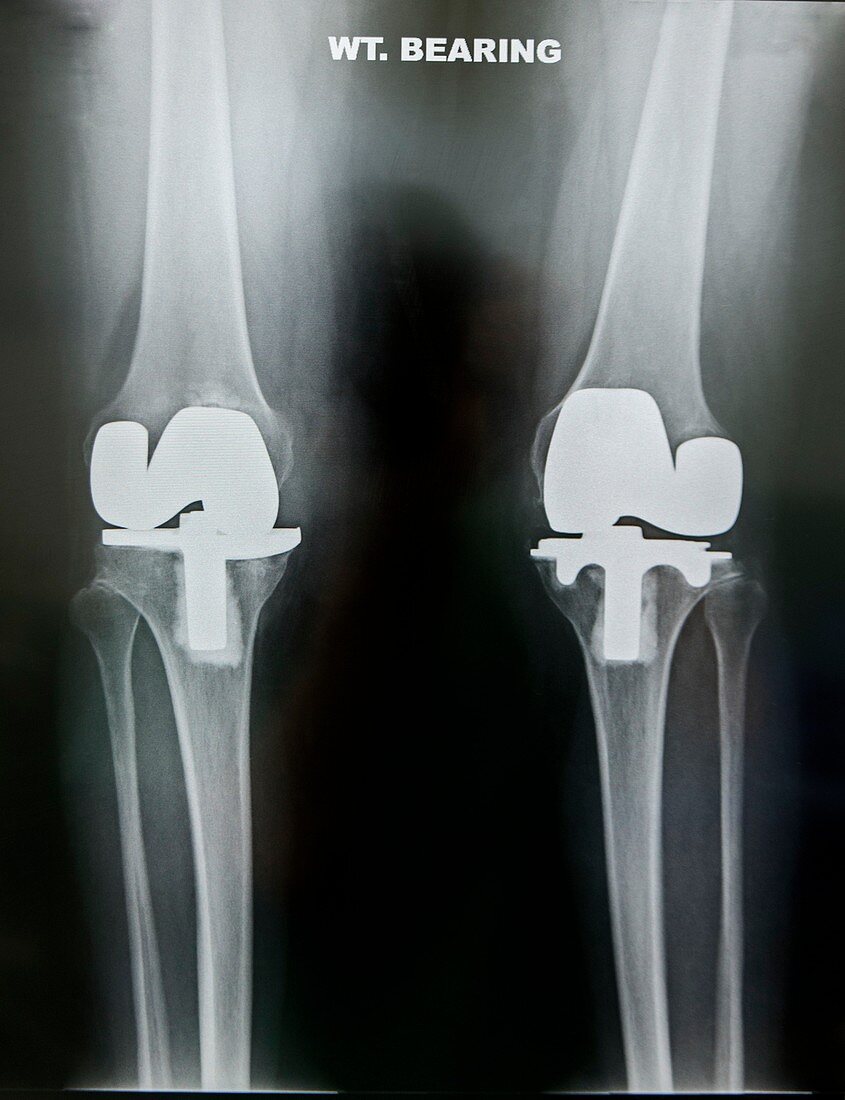 Artificial knee joints in obesity,X-ray
