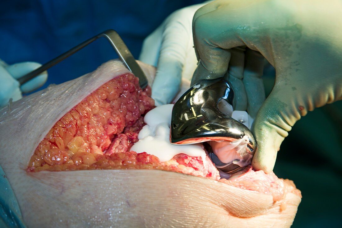 Knee replacement surgery,obese patient