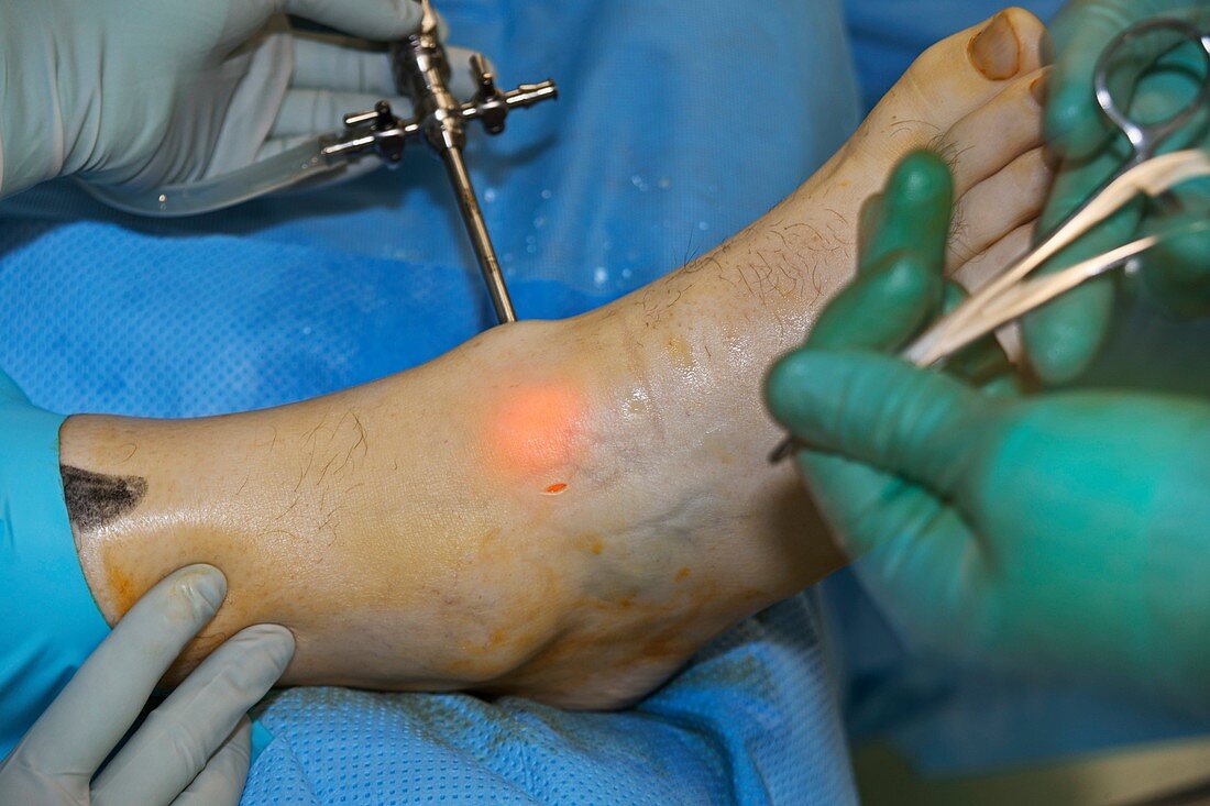 Ankle arthroscopy