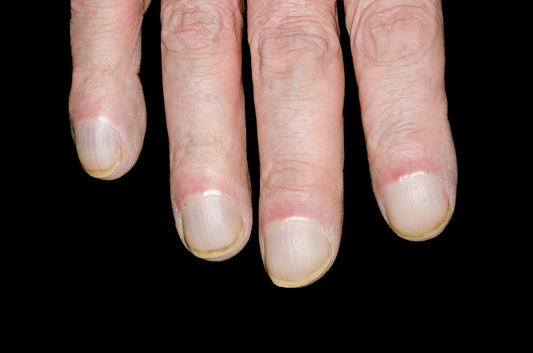 Clubbed fingernails