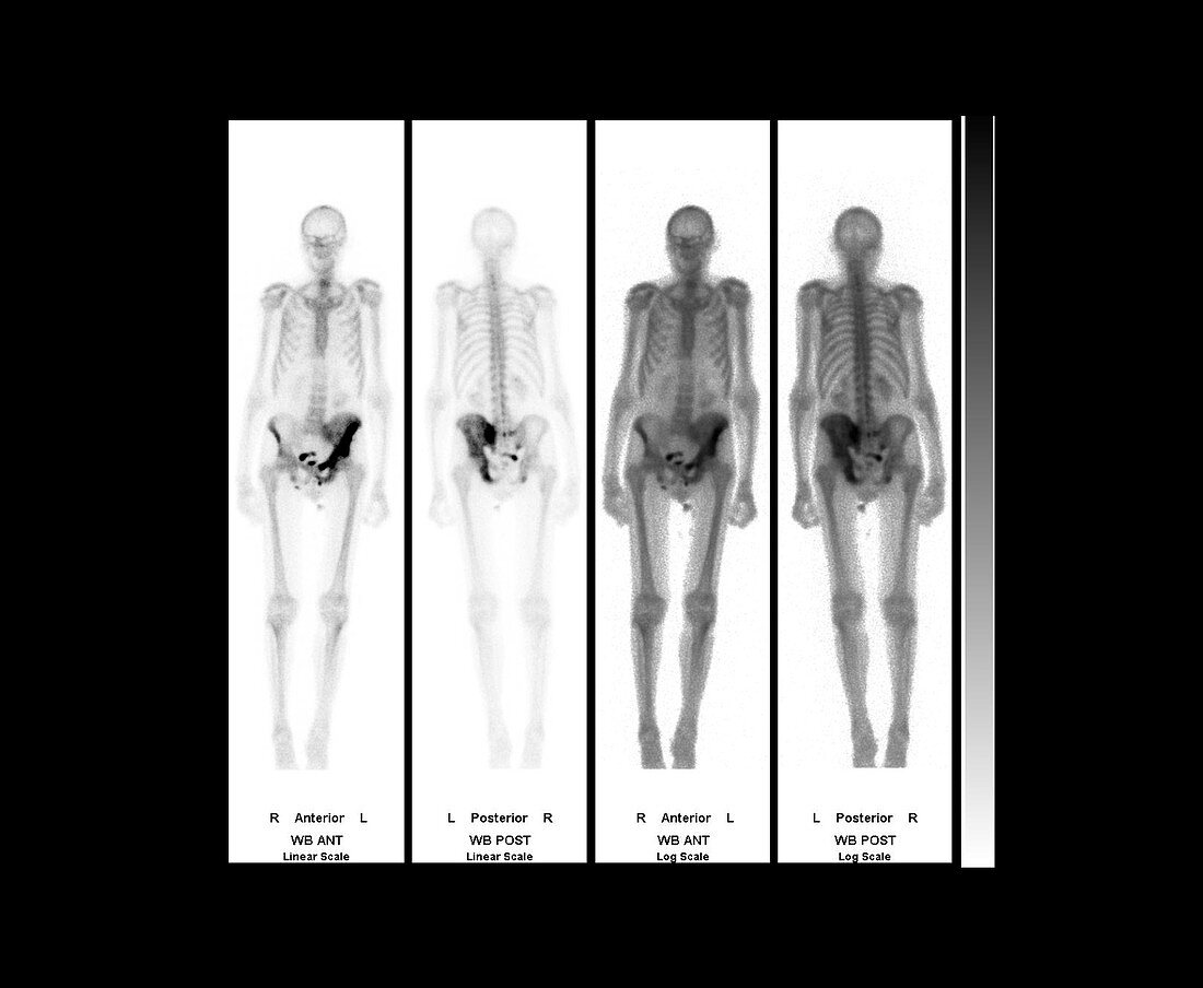 Bone cancer,gamma scans