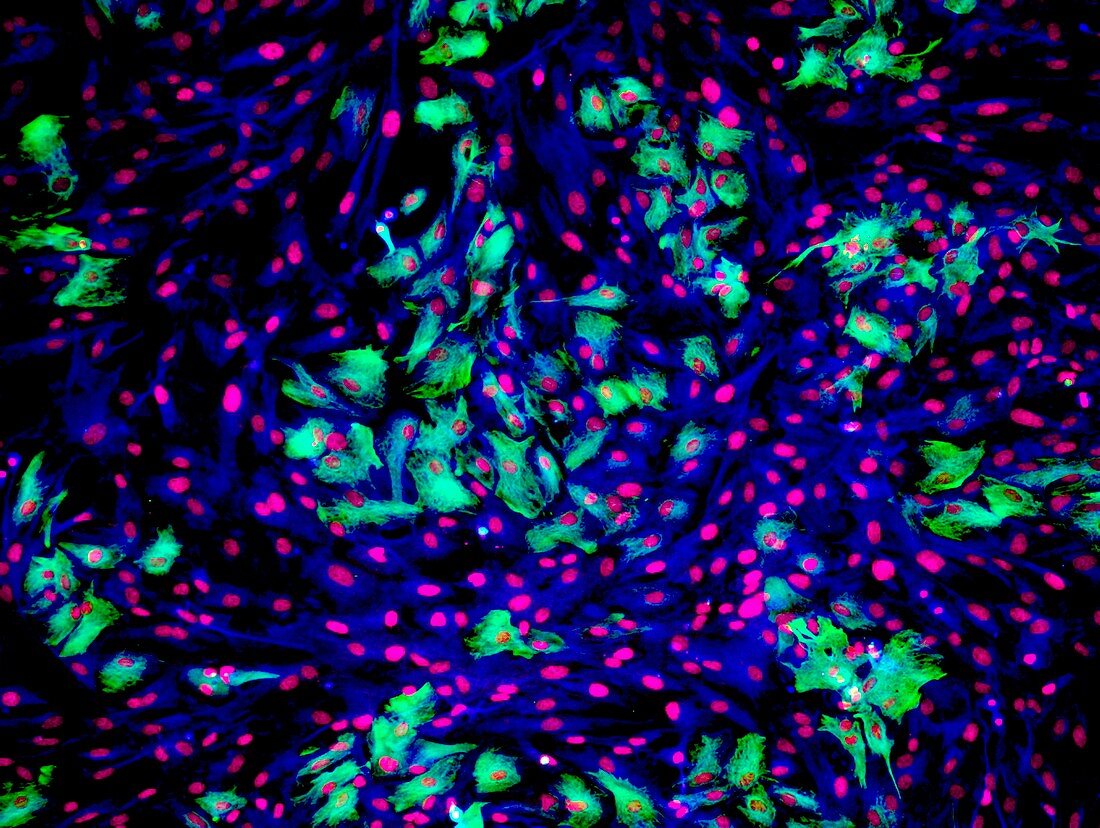 Astrocyte brain cells,light micrograph