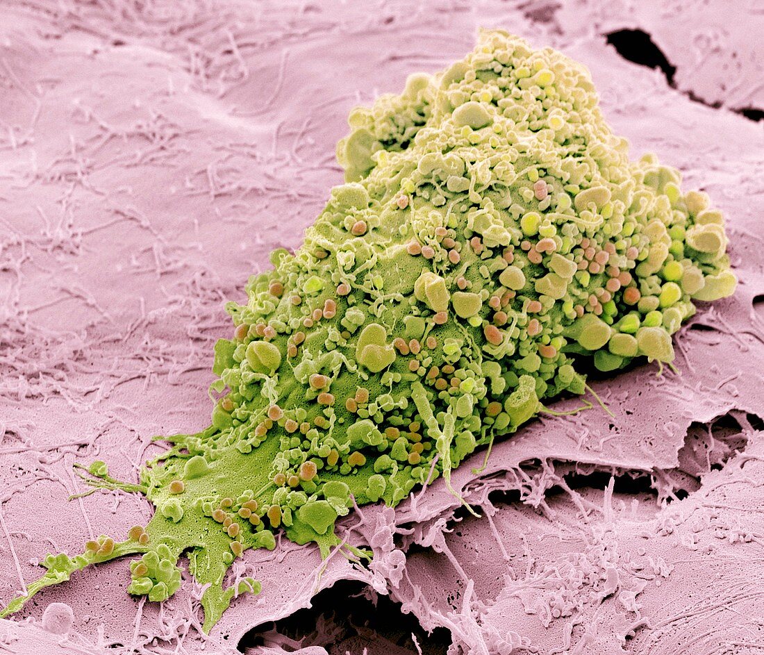Bone cancer cell,SEM