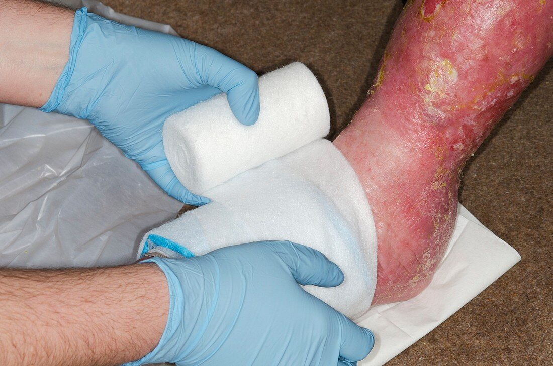 Infected leg ulcer being dressed