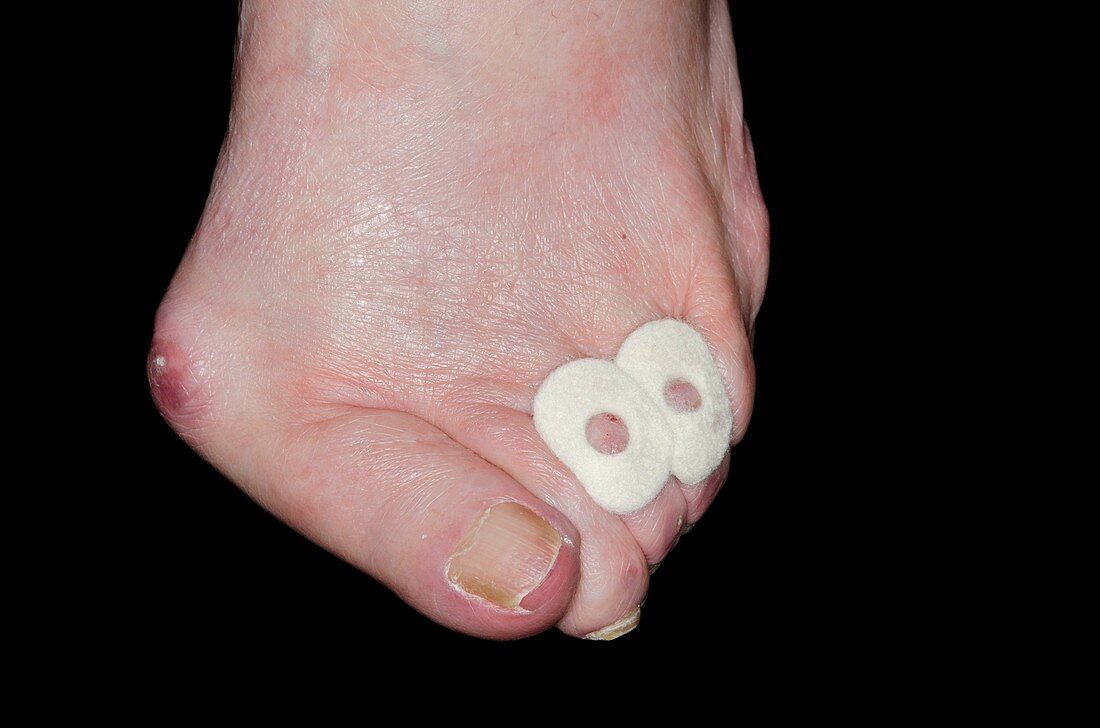 Bunion and corns on the foot