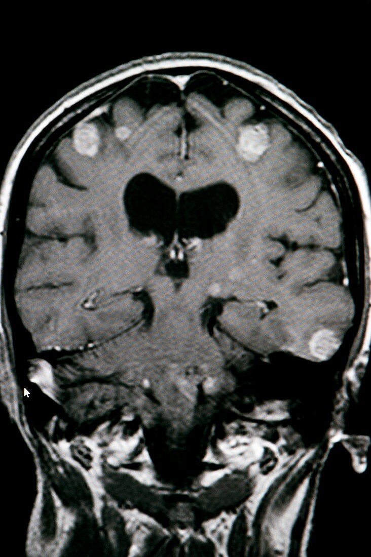 Melanoma brain cancer,CT scan