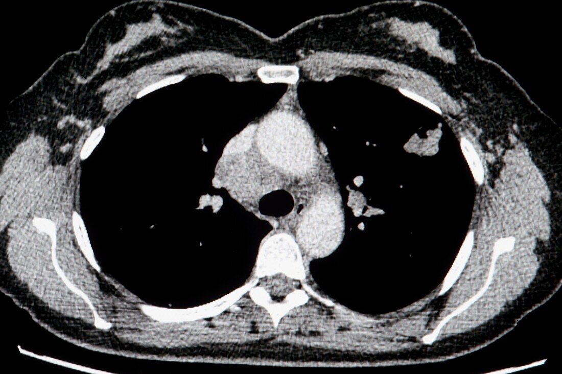 Melanoma lung cancer,CT scan