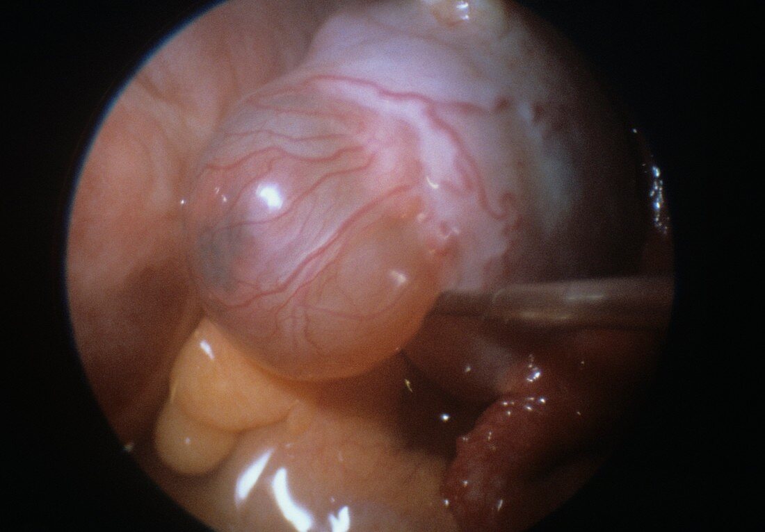 Graafian follicle,endoscope view
