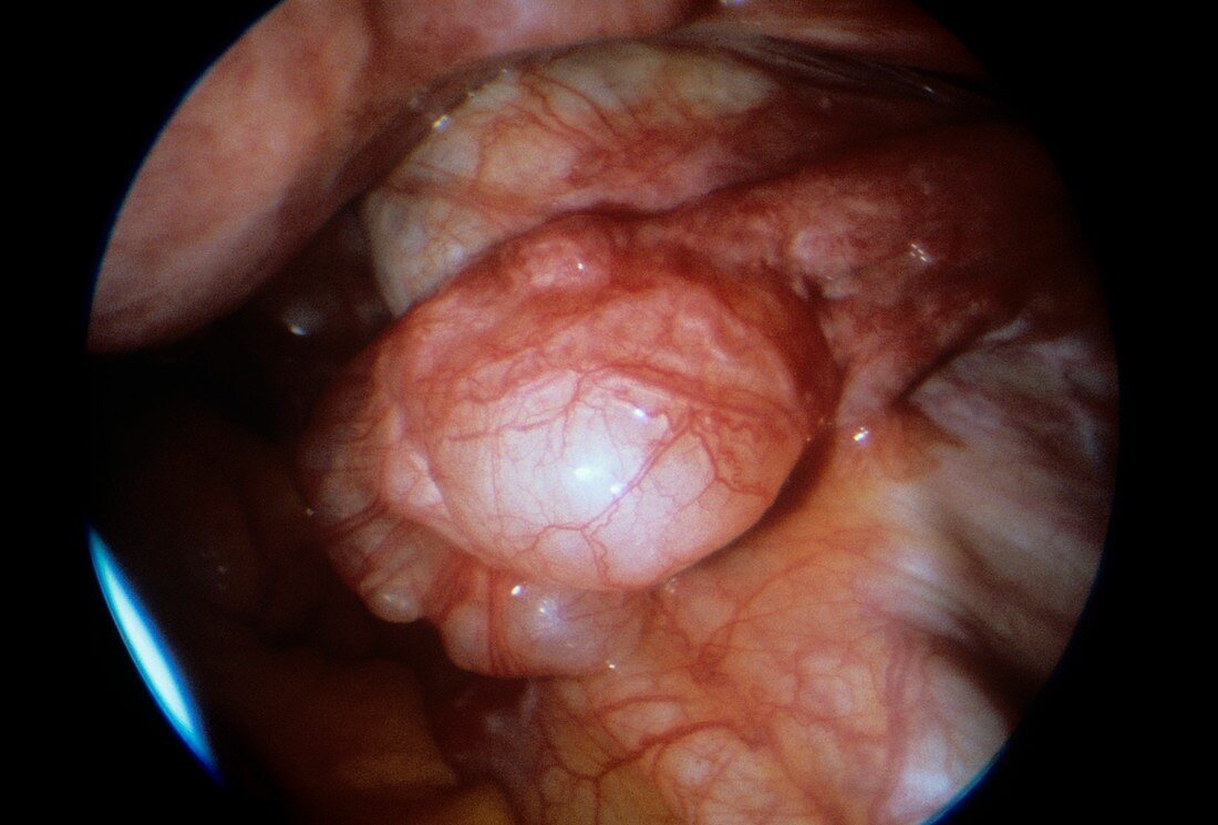 Fallopian tube cyst,endoscope view