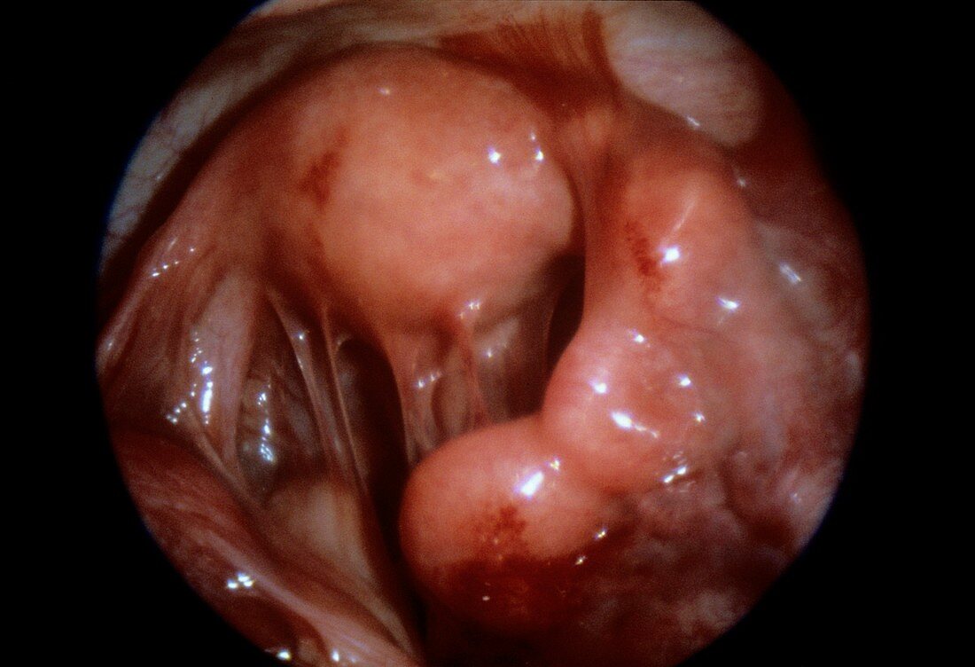 Pelvic peritonitis,endoscope view