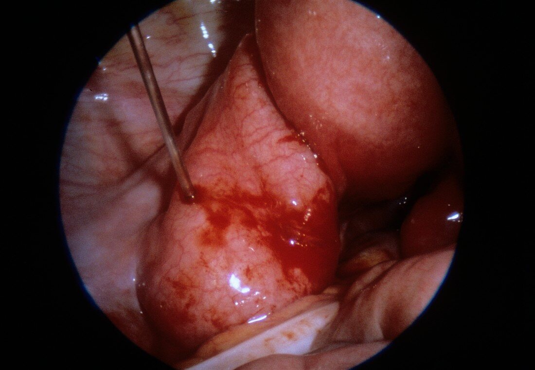 Pyosalpinx of fallopian tube