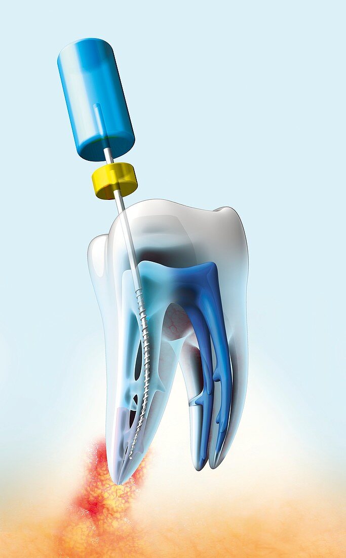 Root canal dental treatment,artwork