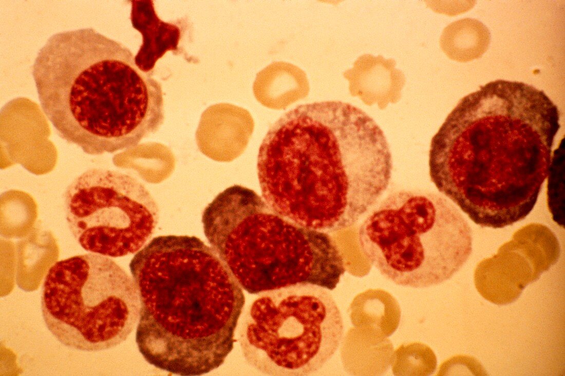 Pernicious anaemia,light micrograph