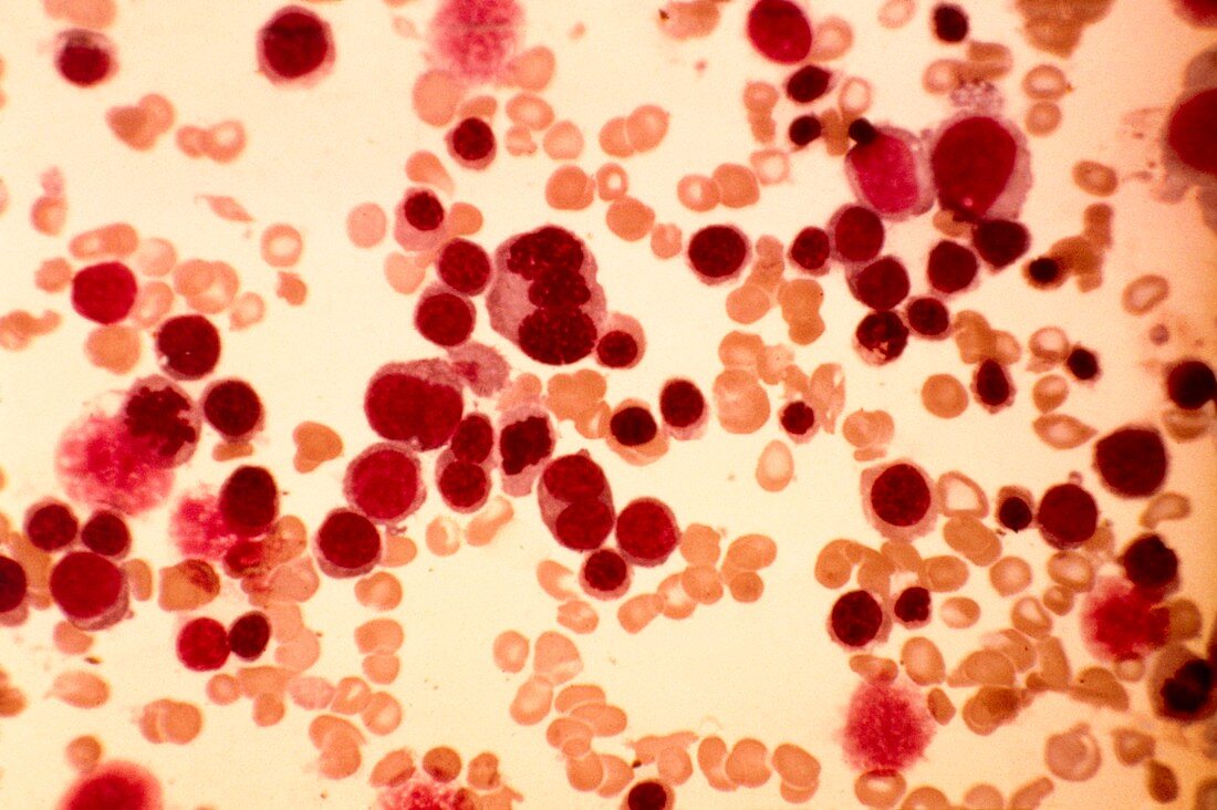 Acute erythroid leukaemia,micrograph