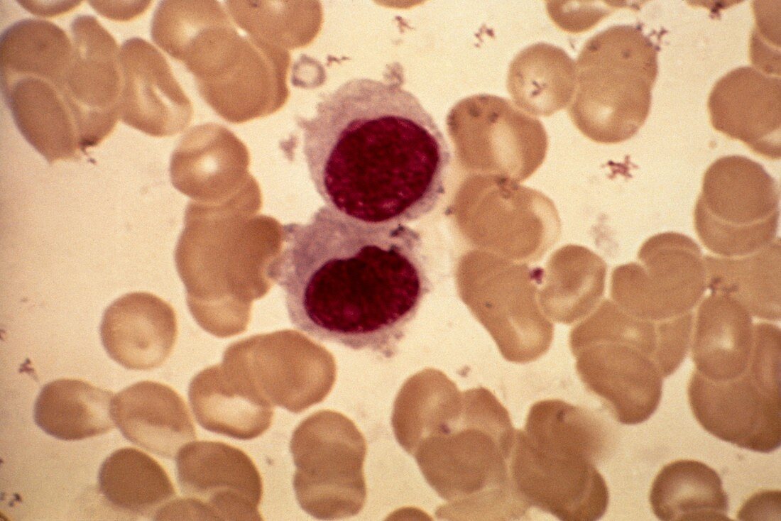 Malignant histiocytosis,light micrograph