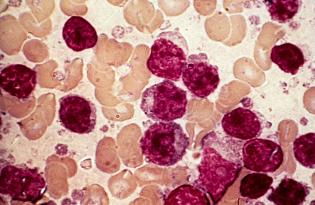 Chronic lymphocytic leukaemia,micrograph