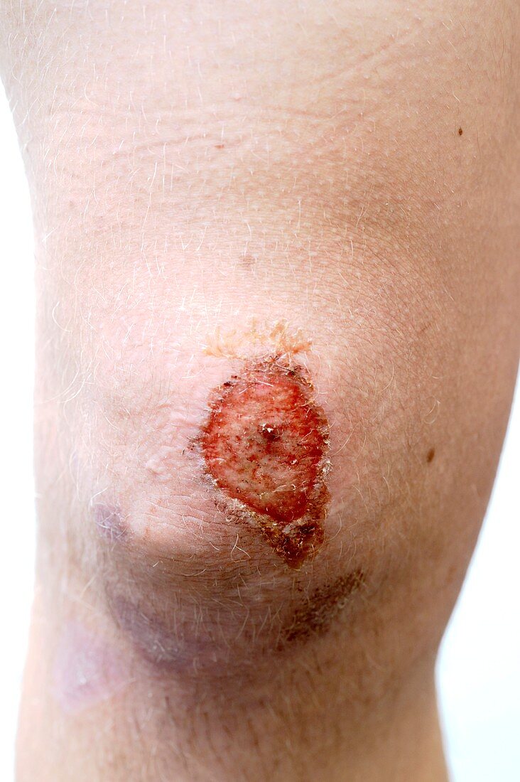 Abrasion of the knee