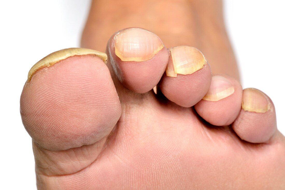 Clubbed toes