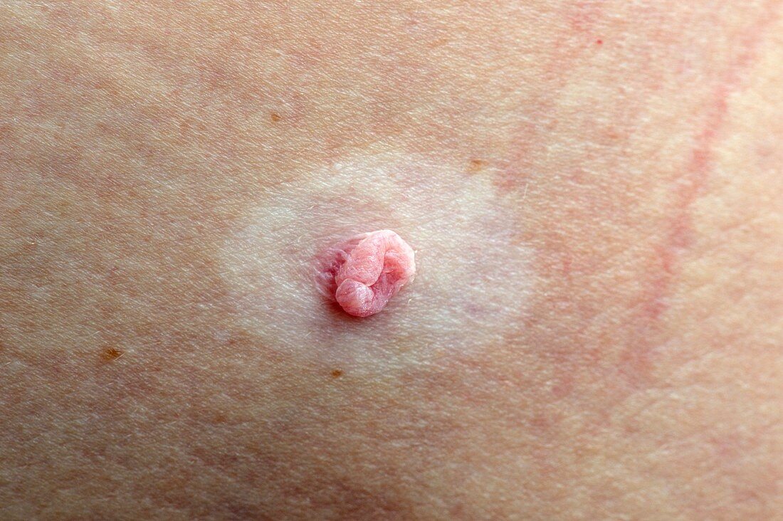Mole on the skin