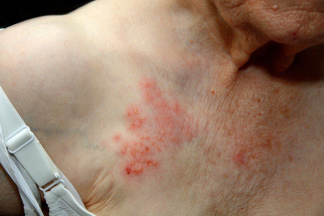 Shingles rash