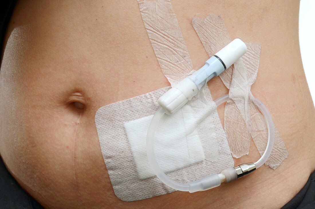 Peritoneal dialysis site on abdomen