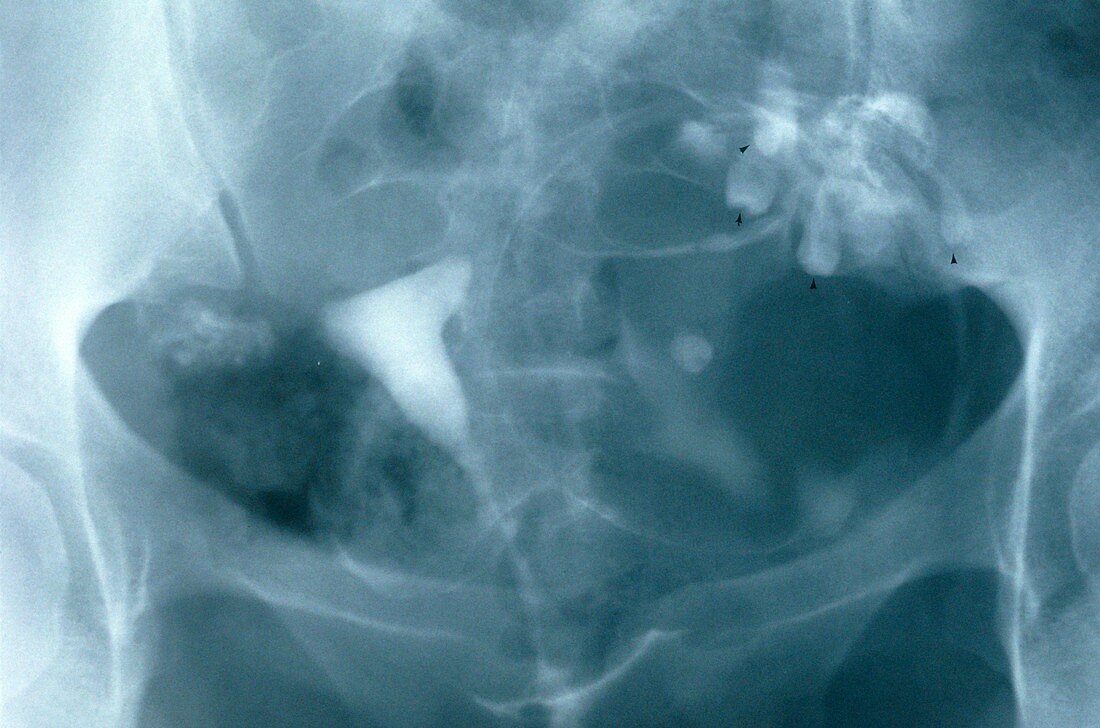 Ovarian dermoid cyst,X-ray
