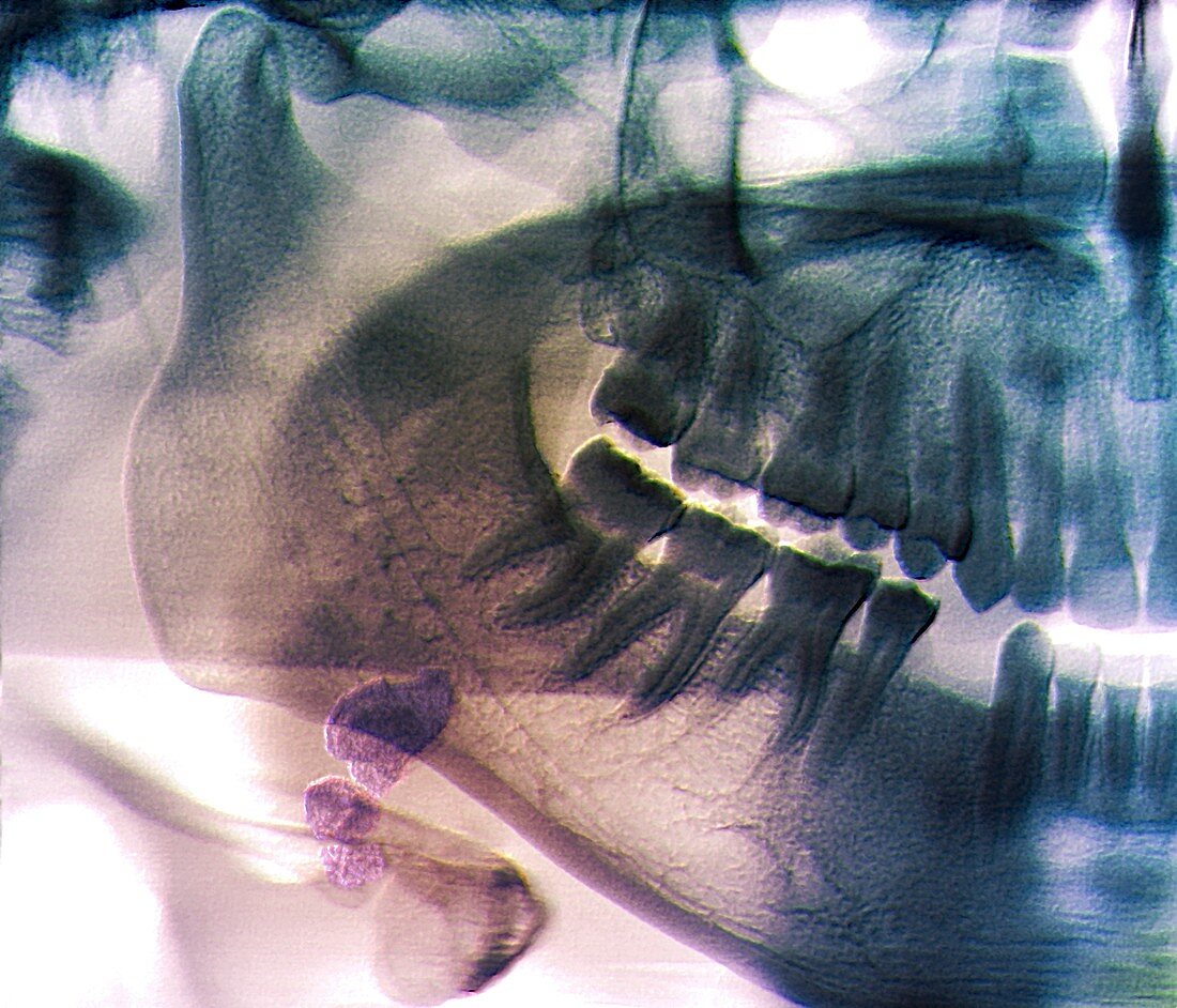 Salivary gland stone,X-ray