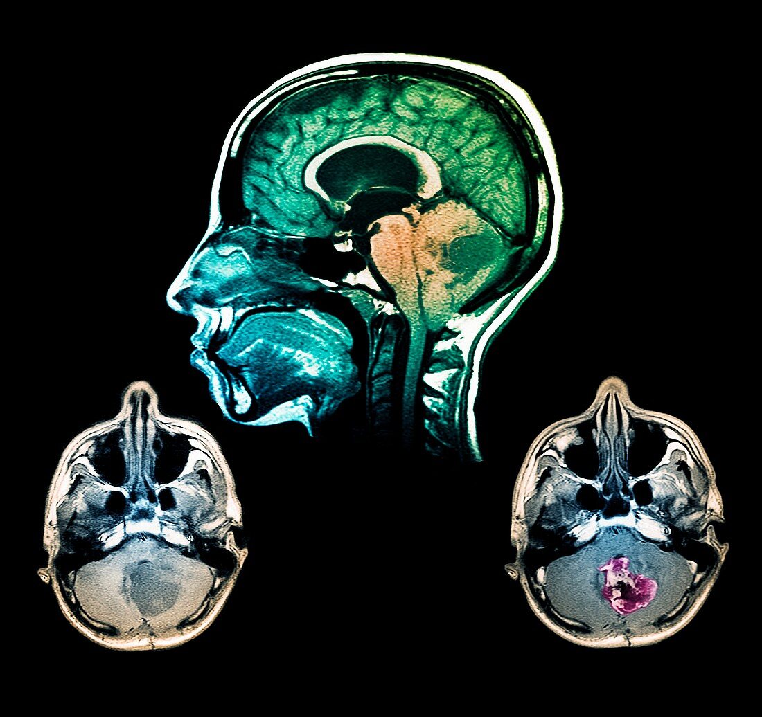Brain tumour,MRI scans