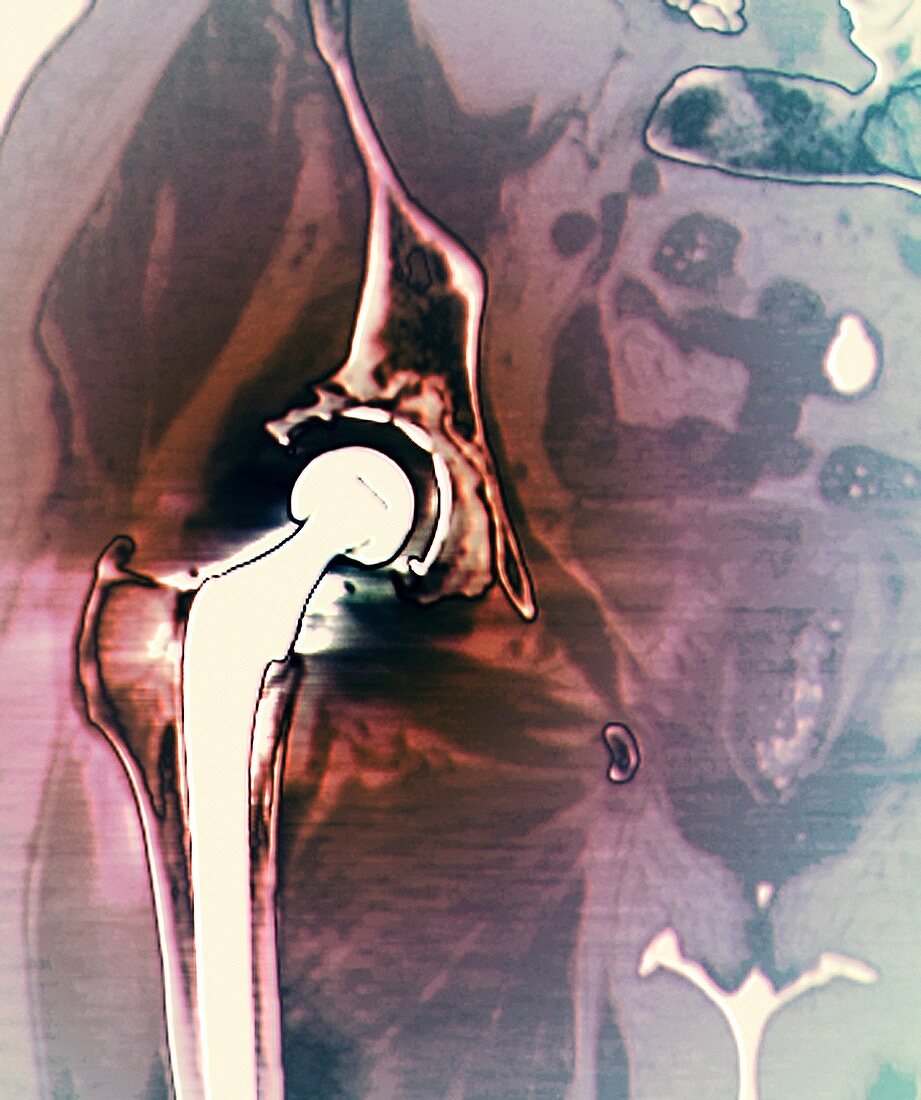 Failed hip replacement,CT scan