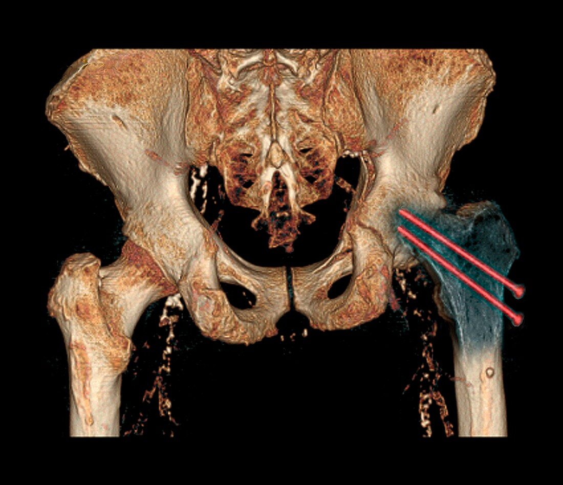 Hip fracture reduction,3D CT scan