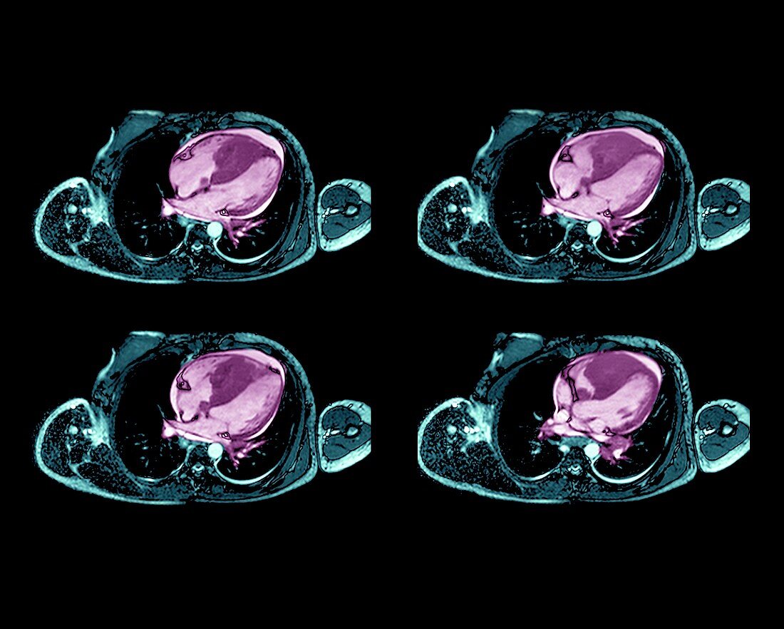 Cardiac lymphoma,MRI scans