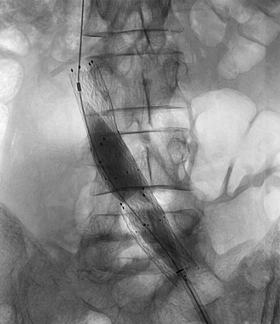 Balloon angioplasty,X-ray