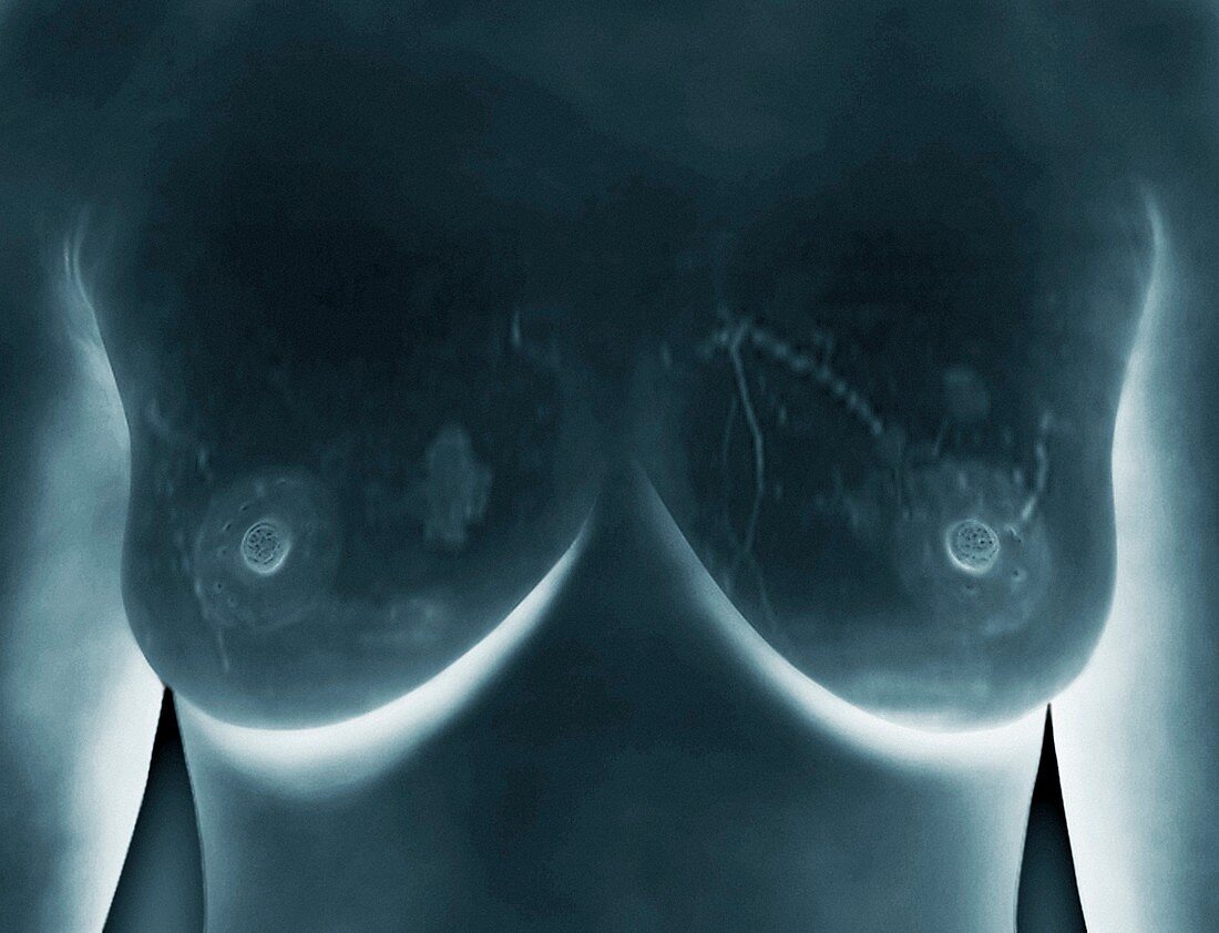 Breast lumps,MRI
