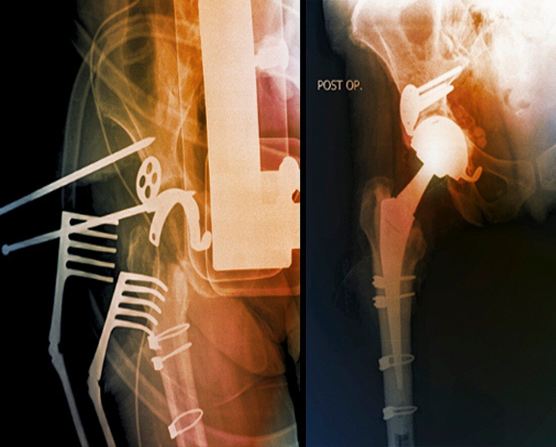 Total hip replacement,X-rays