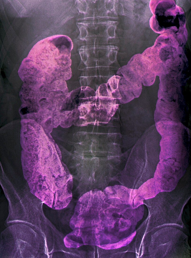 Constipation,X-ray