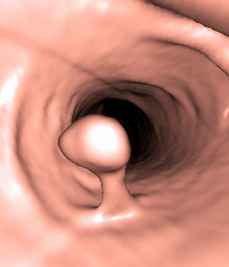 Colon polyp,3D colonoscopy image