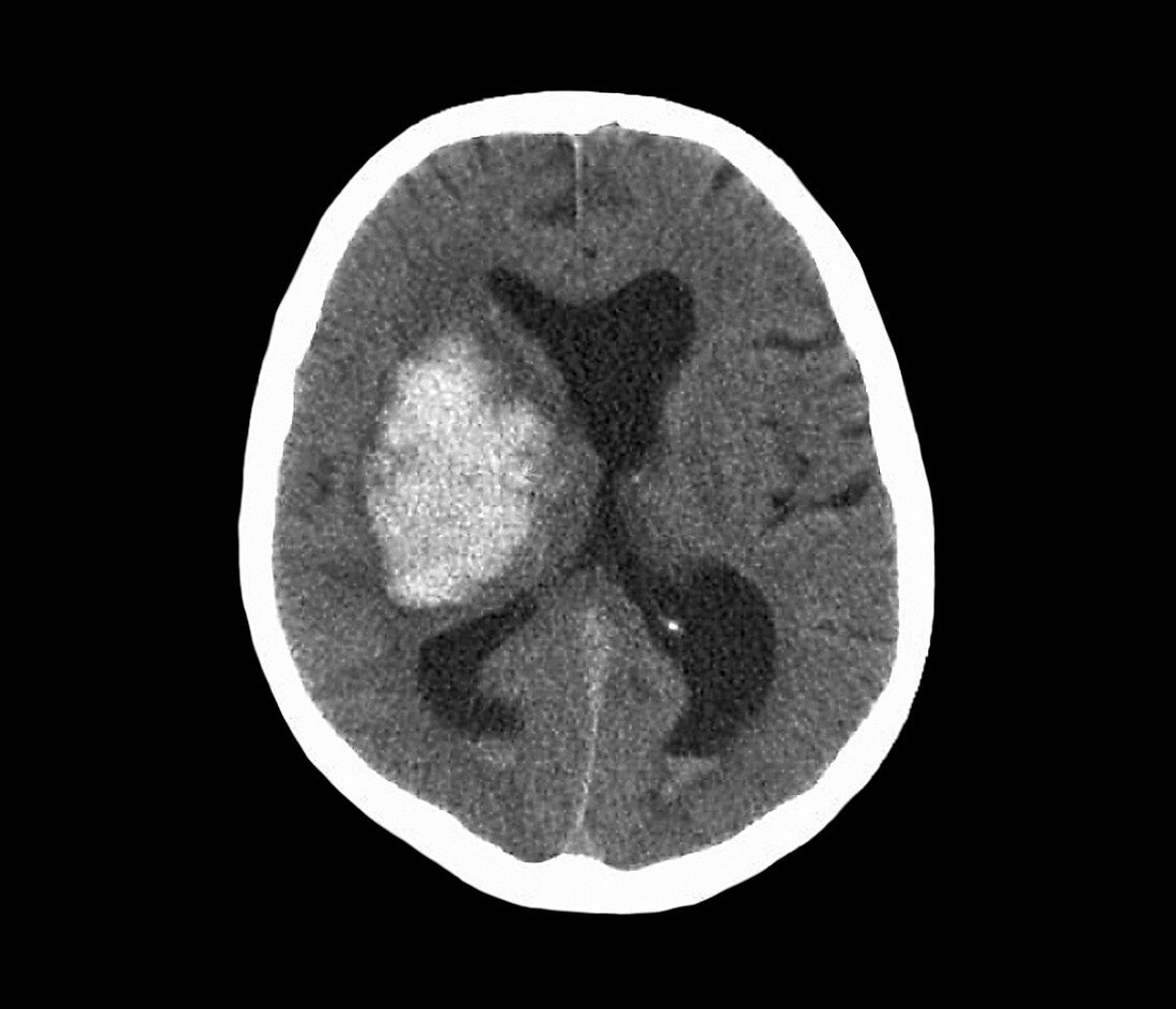 Stroke,CT scan