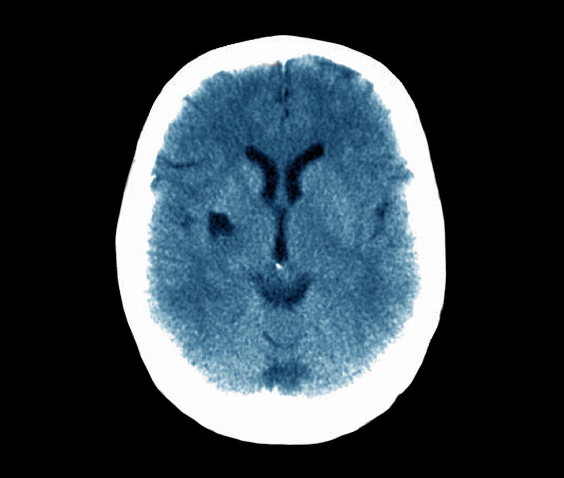 Stroke,CT scan