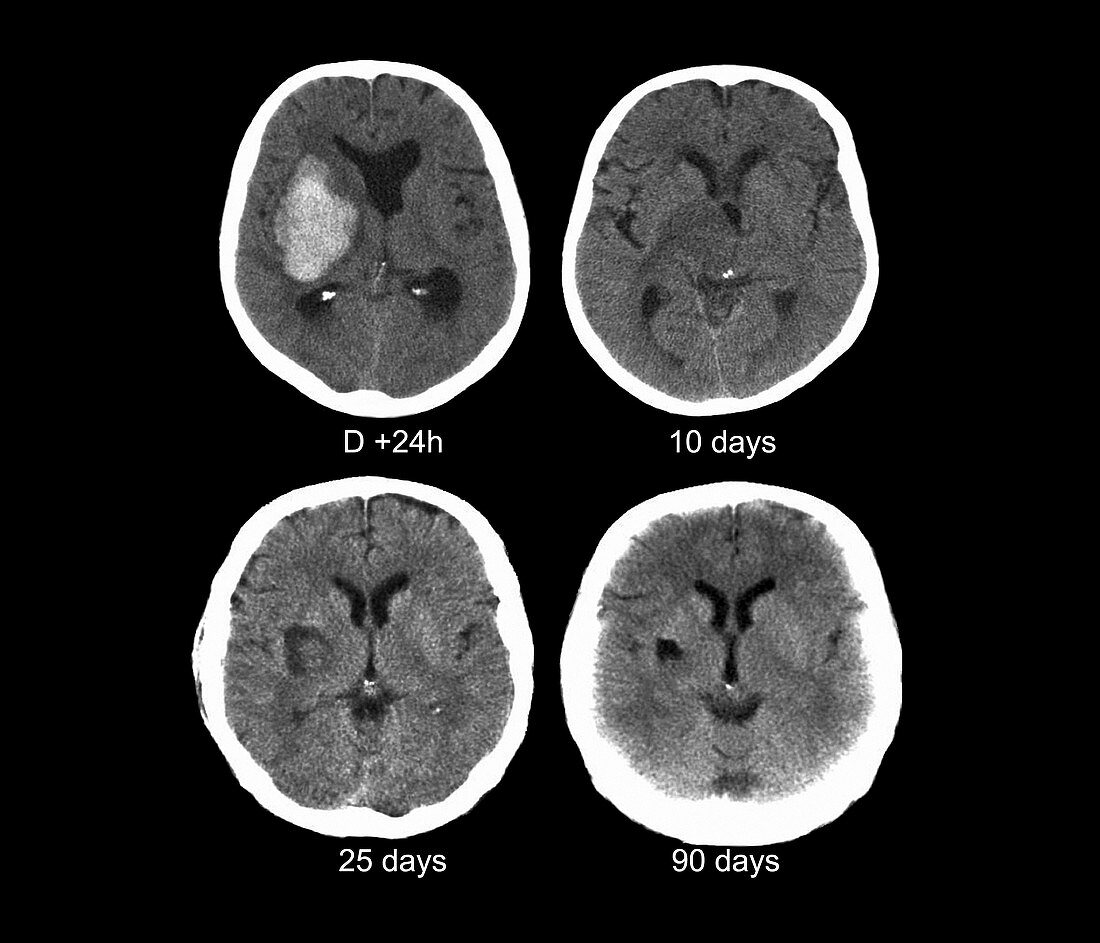 Stroke,CT scans