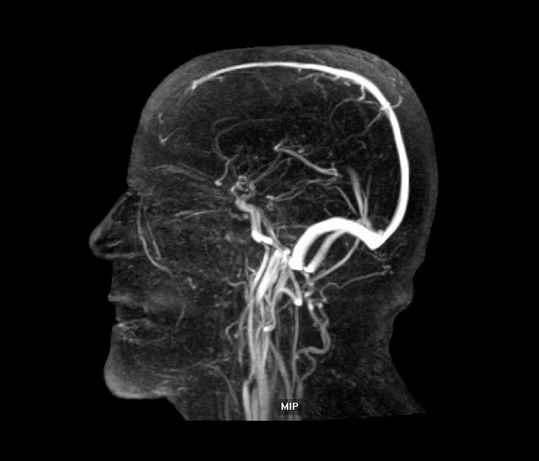 Vascular system of the head,MRI scan